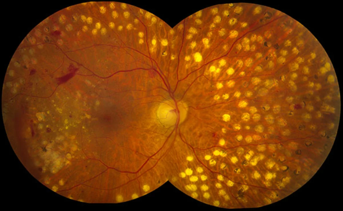 Brimonidine tartrate: A promising treatment for retinal diseases?